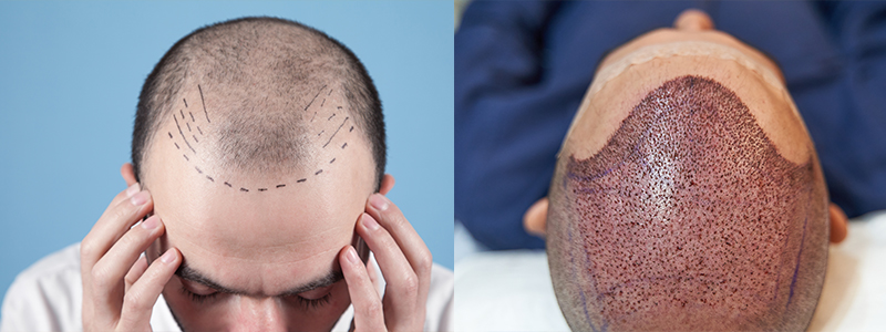 Hair Transplant